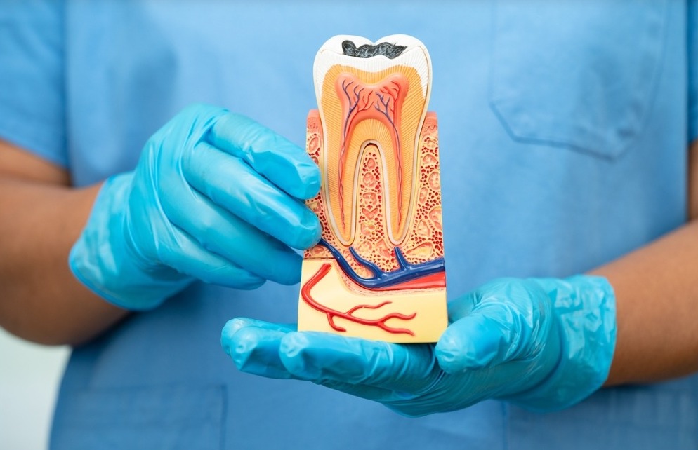 علاج الجذور